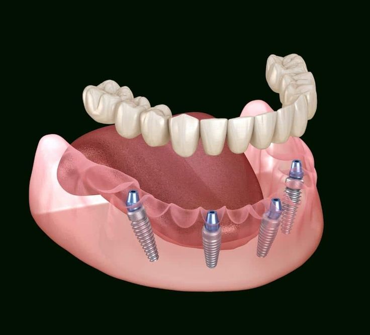 Implantes Dentários